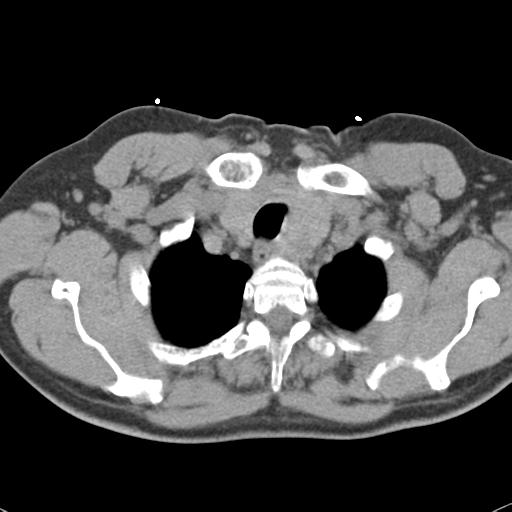 Aortic intramural hematoma (Radiopaedia 31139-31838 Axial non-contrast 7).jpg