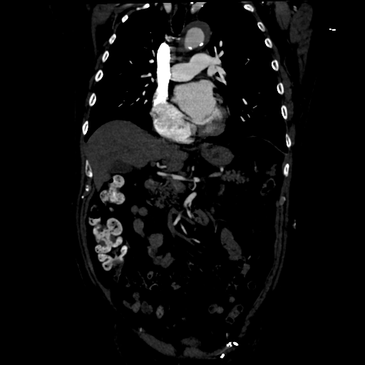 Aortic intramural hematoma (Radiopaedia 34260-35540 C 38).png