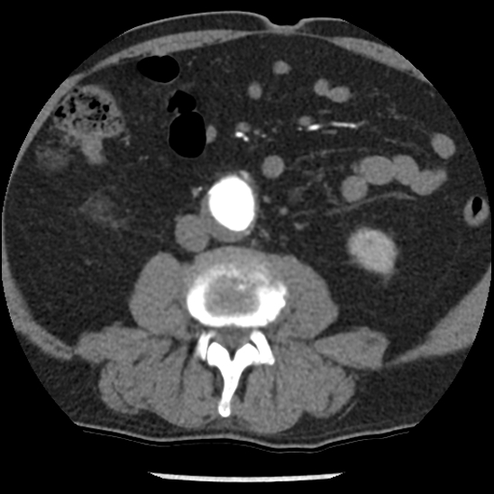 File:Aortic intramural hematoma (type B) (Radiopaedia 79323-92387 B 78).jpg