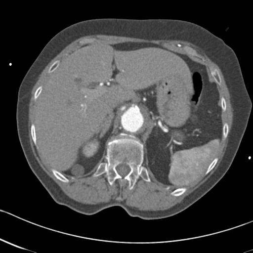 Aortic intramural hematoma from penetrating atherosclerotic ulcer (Radiopaedia 31137-31836 A 80).jpg