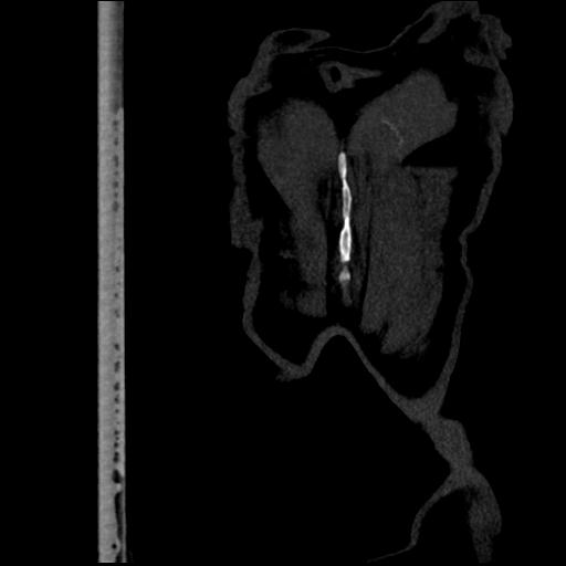File:Aortic intramural hematoma from penetrating atherosclerotic ulcer (Radiopaedia 31137-31836 C 69).jpg