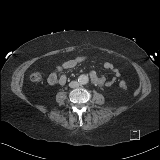 File:Aortic intramural hematoma with dissection and intramural blood pool (Radiopaedia 77373-89491 E 50).jpg
