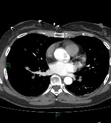 Aortic valve endocarditis (Radiopaedia 87209-103485 C 52).jpg