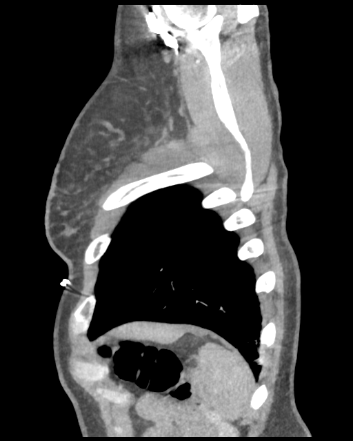 Aortic valve non-coronary cusp thrombus (Radiopaedia 55661-62189 D 7).png