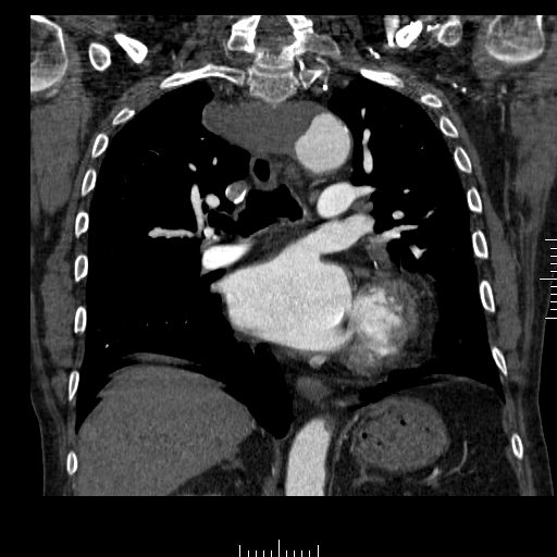 File:Aorto-coronary bypass graft aneurysms (Radiopaedia 40562-43157 B 25).png