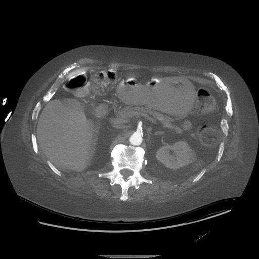 File:Aortoesophageal fistula with endovascular repair (Radiopaedia 73781-84592 Axial 265).jpg