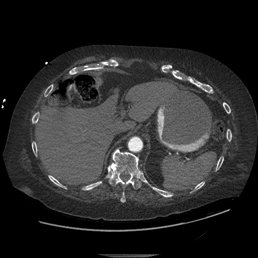 Aortoesophageal fistula with endovascular repair (Radiopaedia 73781-84592 Axial C+ CTPA 162).jpg