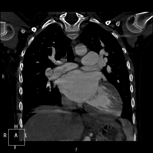 File:Aortopulmonary septal defect (Radiopaedia 41990-45013 Coronal C+ CTPA 33).jpg