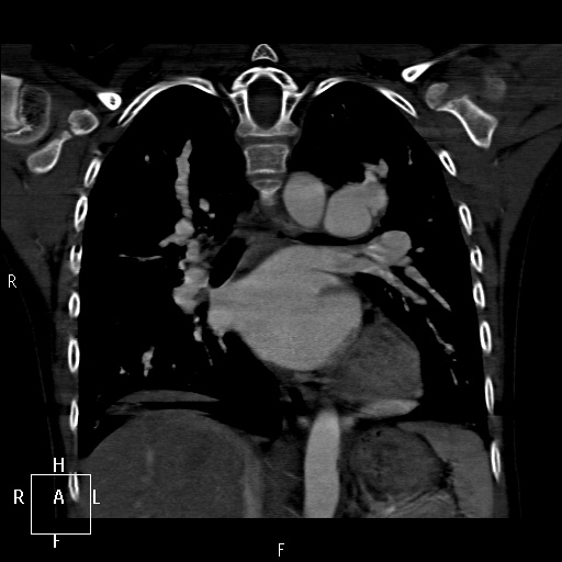 File:Aortopulmonary septal defect (Radiopaedia 41990-45013 Coronal C+ CTPA 41).jpg