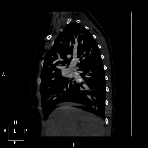 File:Aortopulmonary septal defect (Radiopaedia 41990-45013 Sagittal C+ CTPA 46).jpg