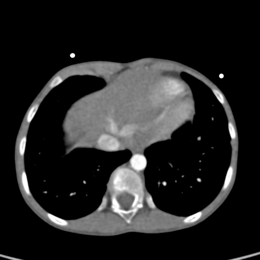 File:Aortopulmonary window, interrupted aortic arch and large PDA giving the descending aorta (Radiopaedia 35573-37074 B 77).jpg
