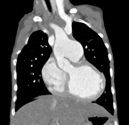 File:Aortopulmonary window, interrupted aortic arch and large PDA giving the descending aorta (Radiopaedia 35573-37074 D 23).jpg