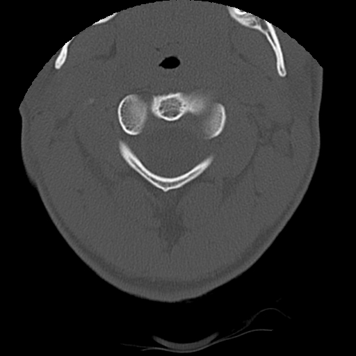 Apical pneumothorax on cervical spine CT (Radiopaedia 45343-49368 Axial bone window 17).jpg