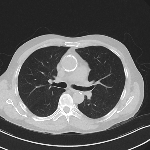 Apical pulmonary metastasis (Radiopaedia 46338-50754 Axial non-contrast 29).png