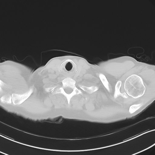 Apical pulmonary metastasis (Radiopaedia 46338-50754 Axial non-contrast 4).png