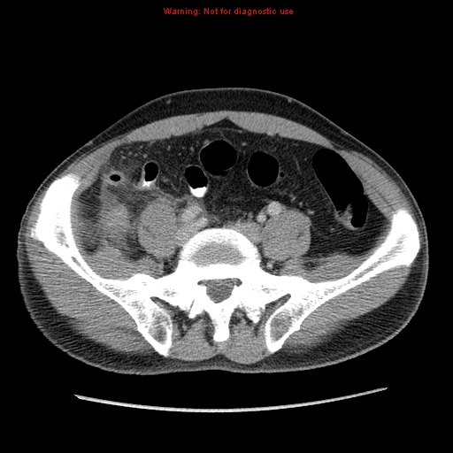 File:Appendicitis and renal cell carcinoma (Radiopaedia 17063-16760 A 41).jpg