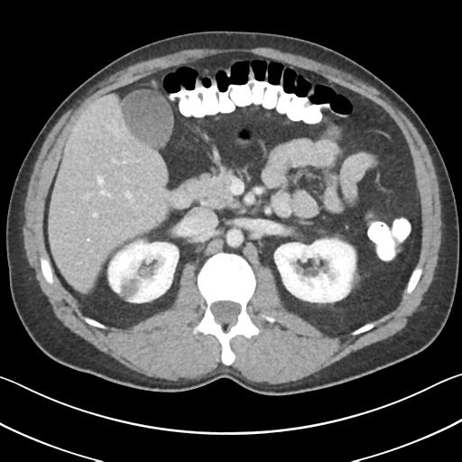 Appendicitis with cecal bar sign (Radiopaedia 31878-32830 B 30).jpg