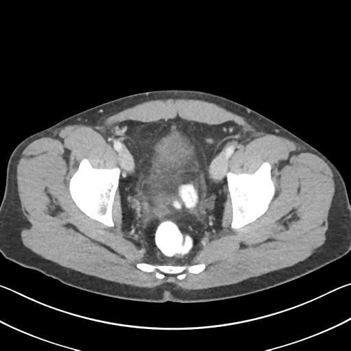 Appendicitis with cecal bar sign (Radiopaedia 31878-32830 B 72).jpg