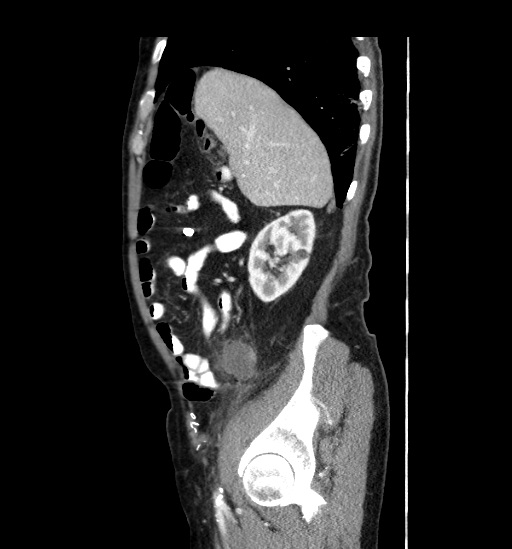 Appendicitis with localized perforation and abscess formation (Radiopaedia 49035-54130 C 16).jpg