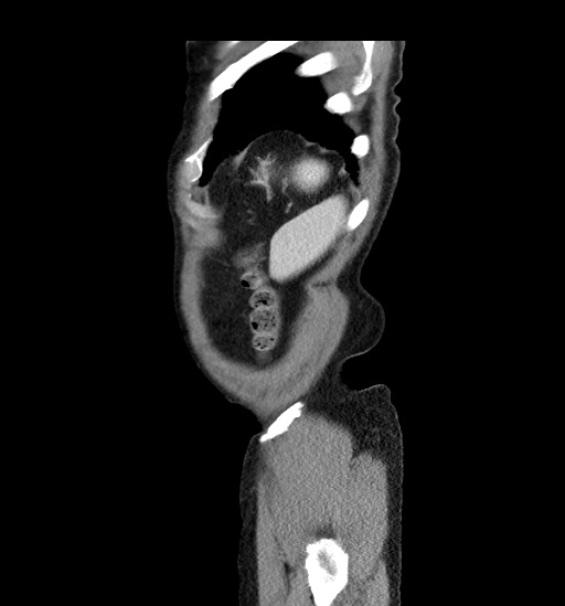 File:Appendicitis with localized perforation and abscess formation (Radiopaedia 49035-54130 C 60).jpg