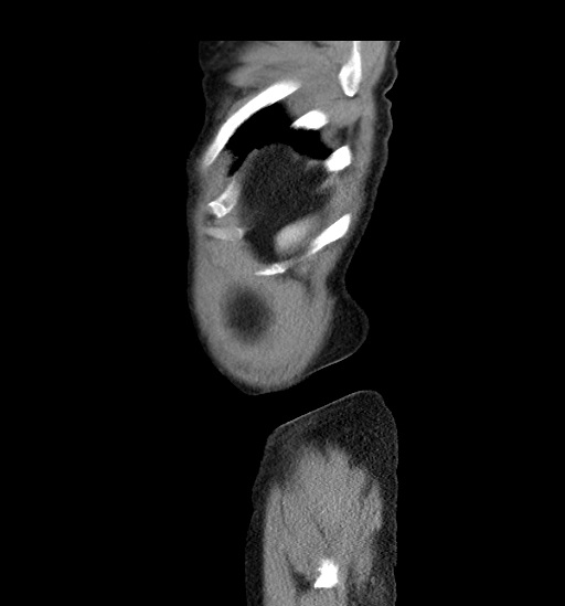 File:Appendicitis with localized perforation and abscess formation (Radiopaedia 49035-54130 C 62).jpg