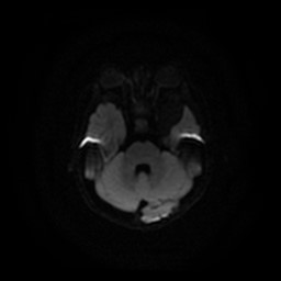Arachnoid cyst - middle cranial fossa (Radiopaedia 86780-102938 Axial DWI 21).jpg