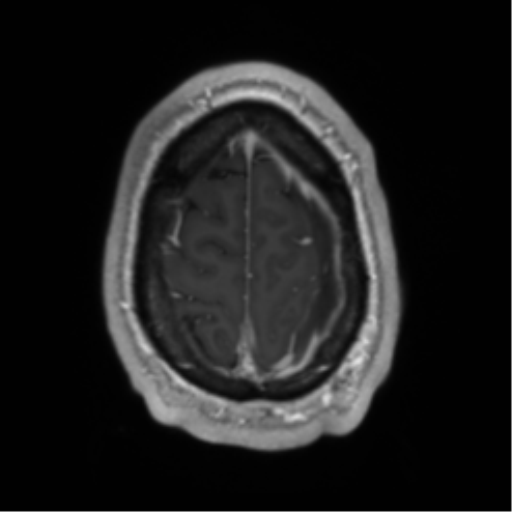 File:Arachnoid cyst with subdural hematoma (Radiopaedia 85892-101743 Axial T1 C+ 74).png