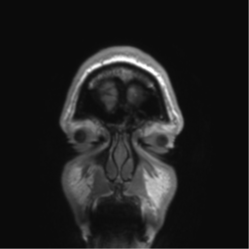 Arachnoid cyst with subdural hematoma (Radiopaedia 85892-101743 Coronal T1 89).png