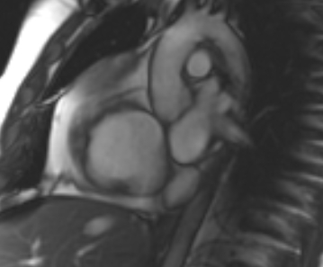 Arrhythmogenic right ventricular cardiomyopathy (Radiopaedia 69431-79307 Short axis cine 235).jpg