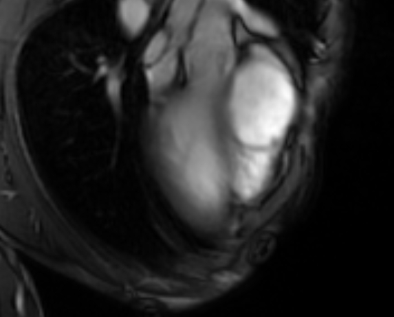 Arrhythmogenic right ventricular cardiomyopathy (Radiopaedia 69564-79464 4ch cine 2).jpg