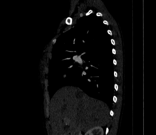 Arteria lusoria (Radiopaedia 88528-105192 C 38).jpg