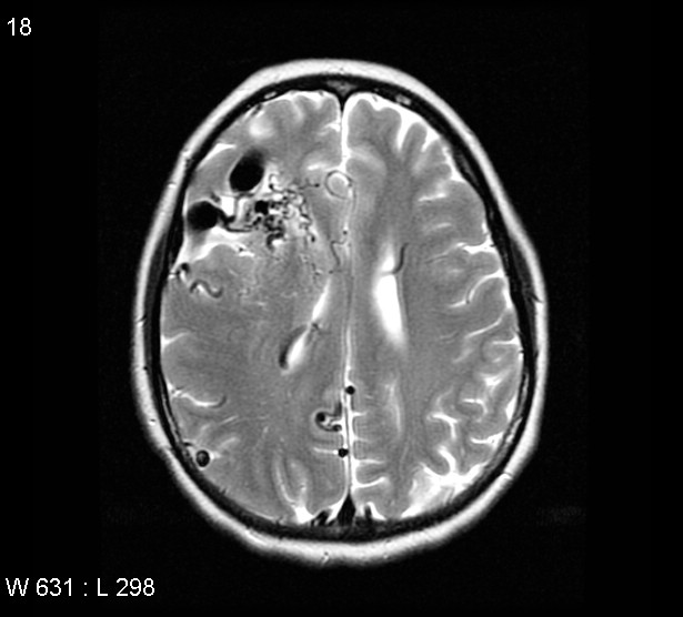 File:Arteriovenous malformation - cerebral (Radiopaedia 4000-6538 Axial T2 12).jpg