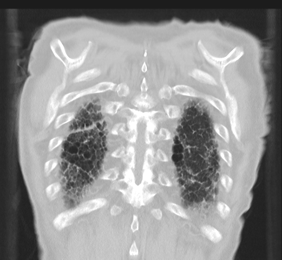 Asbestosis (Radiopaedia 56192-62864 Coronal lung window 46).png