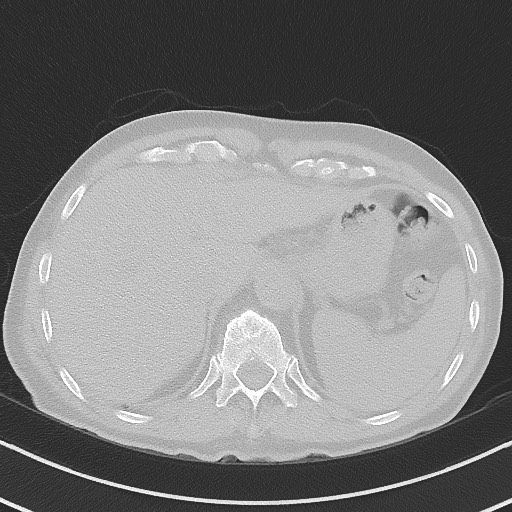 Aspergilloma on background pulmonary fibrosis (Radiopaedia 60942-68757 A 52).jpg