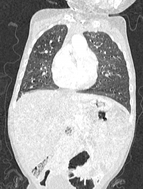 Asplenia syndrome (Radiopaedia 73083-83792 Coronal lung window 51).jpg