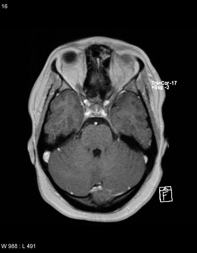 Astroblastoma (Radiopaedia 39792-42217 Axial T1 C+ 15).jpg