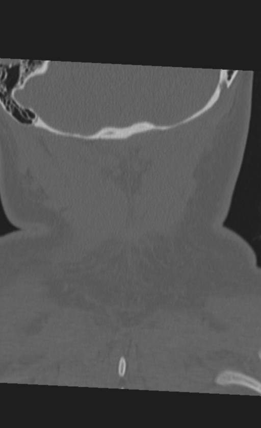 Atlanto-occipital dissociation (Radiopaedia 33848-35013 Coronal bone window 52).png