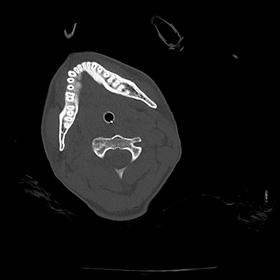 Atlanto-occipital dissociation (Traynelis type 1), C2 teardrop fracture, C6-7 facet joint dislocation (Radiopaedia 87655-104061 Axial bone window 30).jpg