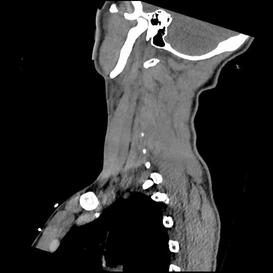 File:Atlanto-occipital dissociation (Traynelis type 1), C2 teardrop fracture, C6-7 facet joint dislocation (Radiopaedia 87655-104061 D 64).jpg