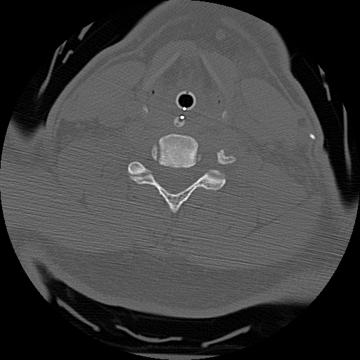 Atlanto-occipital dissociation injury (Radiopaedia 29274-29698 Axial bone window 50).png