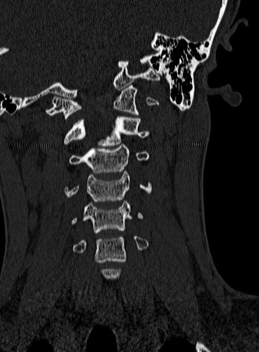 Atlantoaxial subluxation (Radiopaedia 44681-48450 Coronal bone window 48).jpg