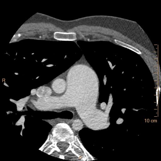 Atrial septal defect (upper sinus venosus type) with partial anomalous pulmonary venous return into superior vena cava (Radiopaedia 73228-83961 A 47).jpg