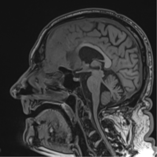 Atypical meningioma (WHO grade II) with brain invasion (Radiopaedia 57767-64729 Sagittal T1 37).png