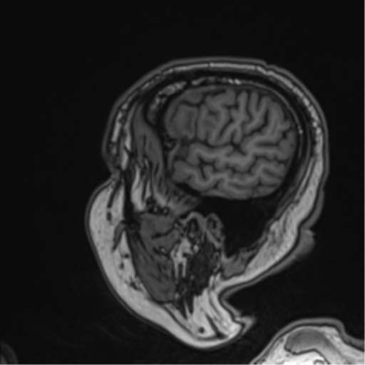 Atypical meningioma (WHO grade II) with brain invasion (Radiopaedia 57767-64729 Sagittal T1 56).png