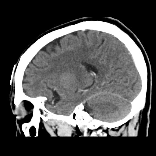 Atypical meningioma (WHO grade II) with osseous invasion (Radiopaedia 53654-59715 G 36).png