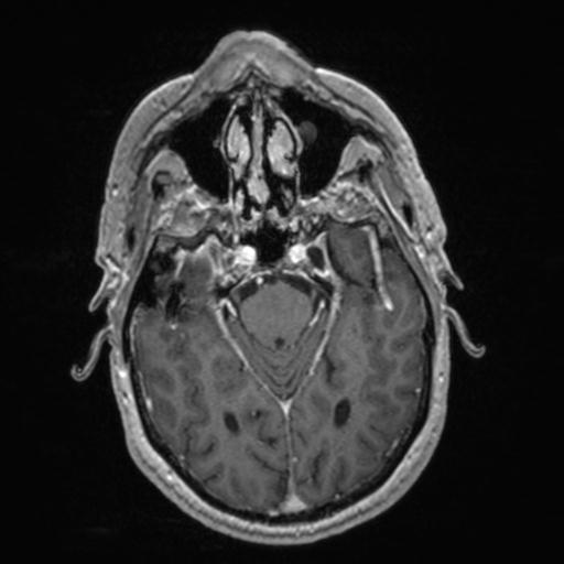 Atypical meningioma (grade II) - en plaque (Radiopaedia 29633-30147 Axial T1 C+ 66).jpg
