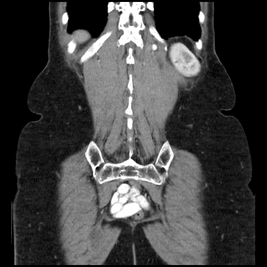 File:Atypical renal cyst (Radiopaedia 17536-17251 C 4).jpg