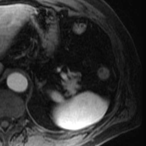 File:Atypical renal cyst on MRI (Radiopaedia 17349-17046 C 2).jpg