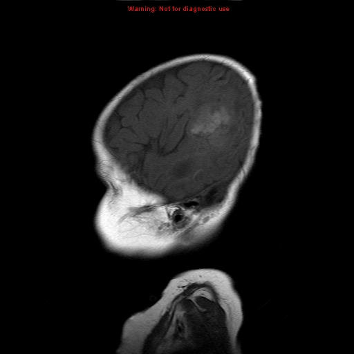 File:Atypical teratoid rhabdoid tumor (Radiopaedia 10712-11183 Sagittal T1 18).jpg