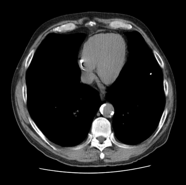 Autosomal dominant polycystic kidney disease (Radiopaedia 27851-28094 Axial non-contrast 41).jpg